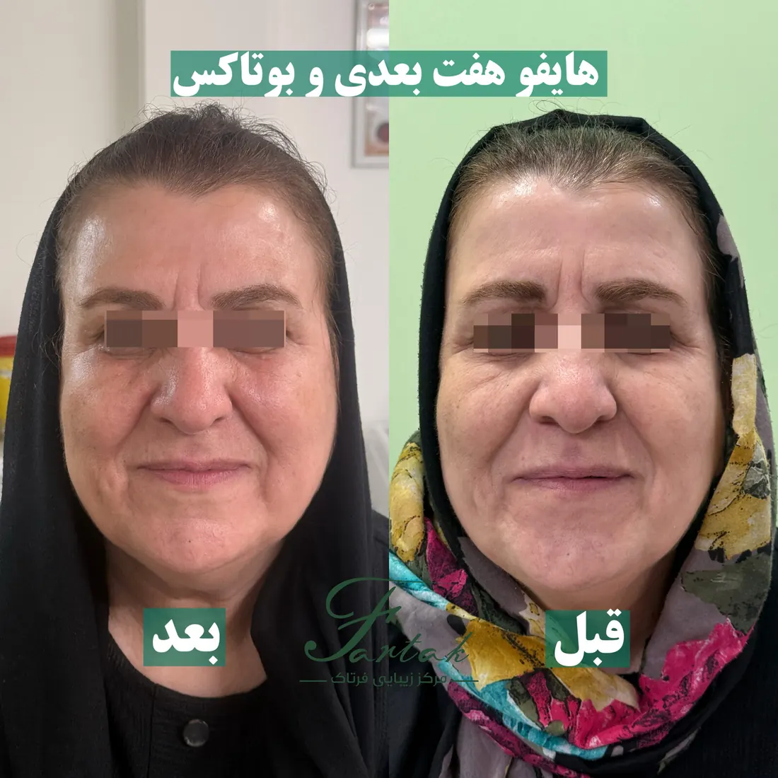 قبل و بعد هایفو هفت‌بعدی و بوتاکس