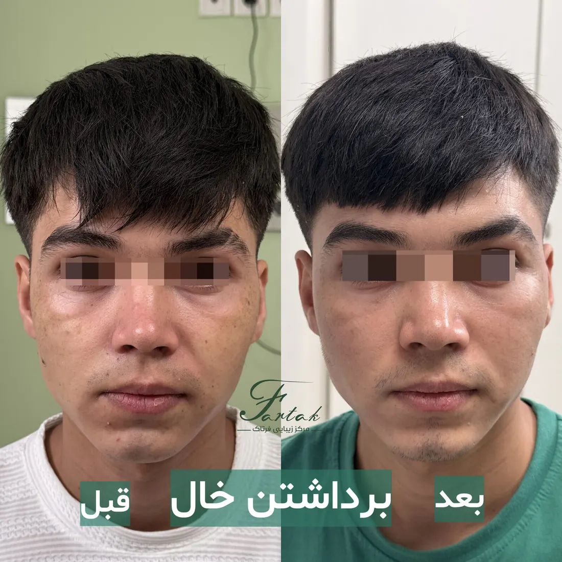 قبل و بعد برداشتن خال صورت