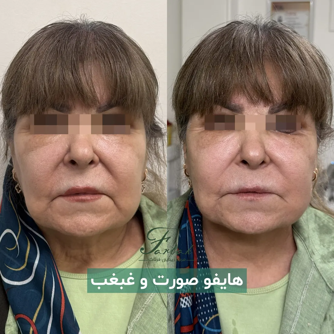 قبل و بعد هایفو صورت و غبغب