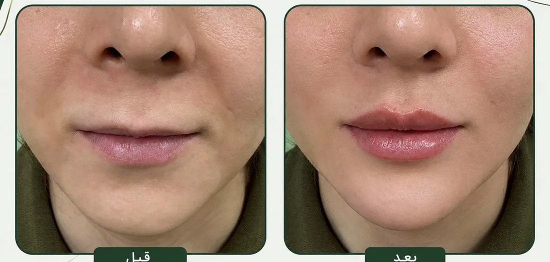 قبل و بعد تزریق چانه و فرم‌دهی لب