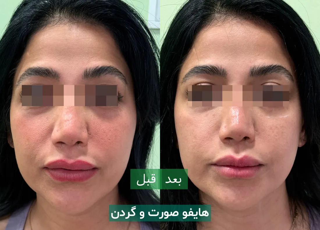 قبل و بعد هایفو صورت و گردن