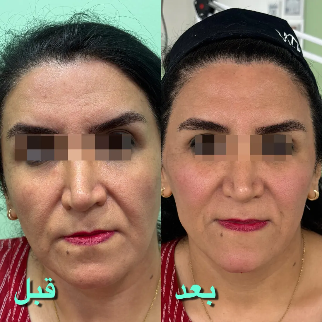 قبل و بعد هایفوتراپی صورت